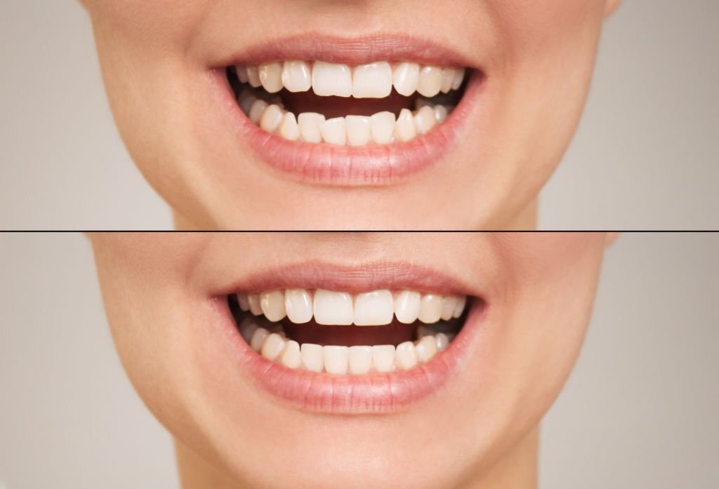 close-up photo of female teeth before and after the installation of the bracket system. The concept of comparison. Dentistry and orthodontics. The result of bite correction.