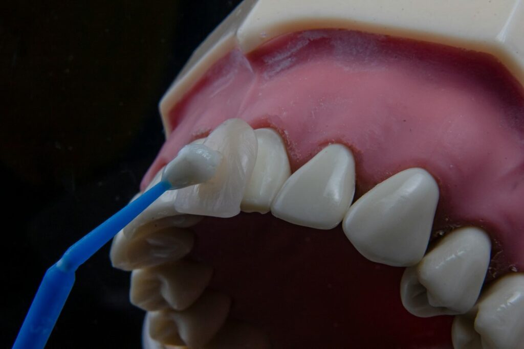 Dental Veneers pros vs cons