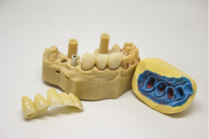 loose teeth treatment bite adjustment